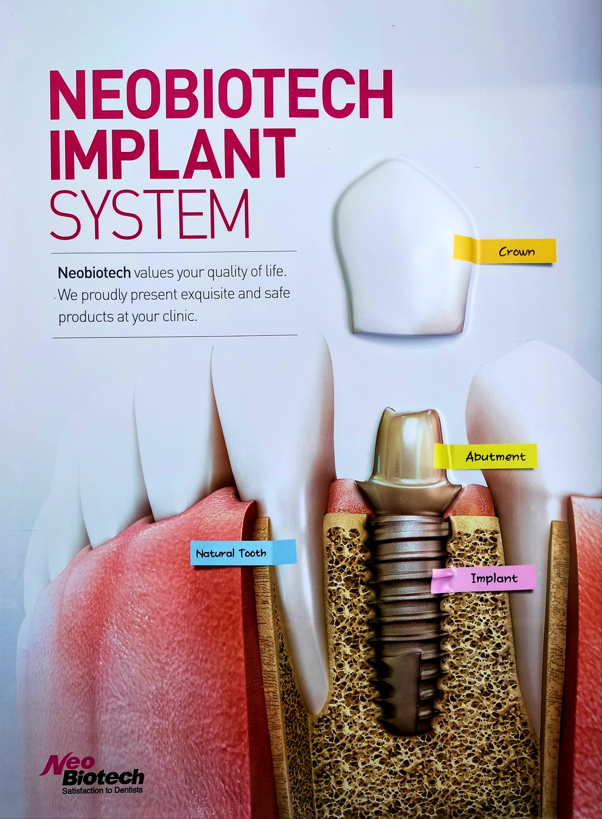 3D Display Poster - Neobiotech Implant System